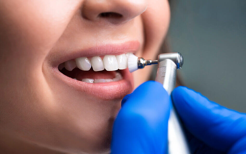 Descubre los beneficios de una limpieza dental profesional en Mérida