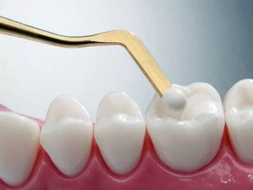 Restauraciones dentales estéticas con resinas de alta calidad en Mérida